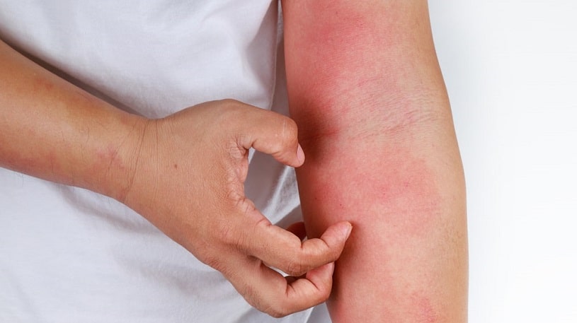 Man with itchy skin due to codeine allergy.