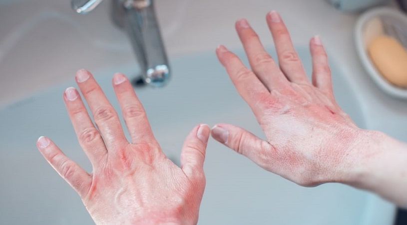 Red hands because of a Soma allergy.
