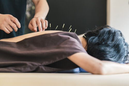 acupuncture as natural pain reliever